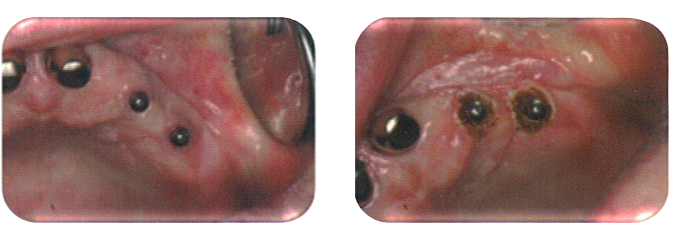 植牙軟組織處理