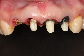 立即植牙及3D立體斷層掃描