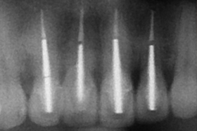 立即植牙及3D立體斷層掃描