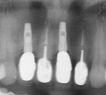 立即植牙及3D立體斷層掃描