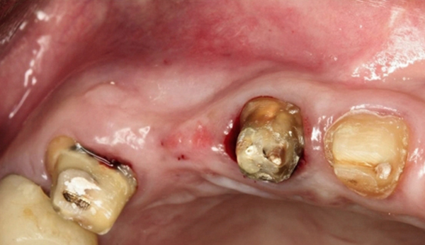 嚴重骨脊萎縮增寬手術