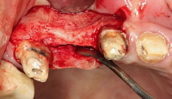 嚴重骨脊萎縮增寬手術