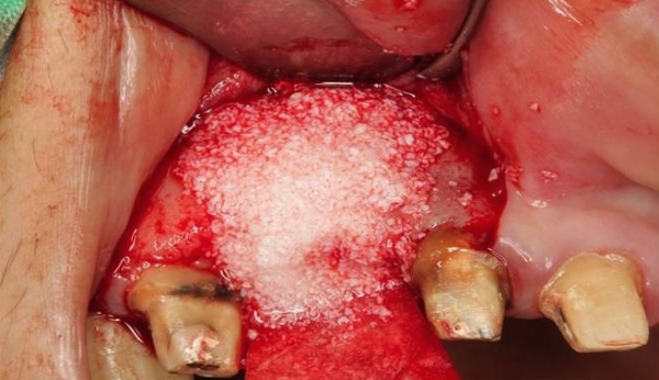 嚴重骨脊萎縮增寬手術