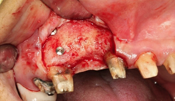 嚴重骨脊萎縮增寬手術