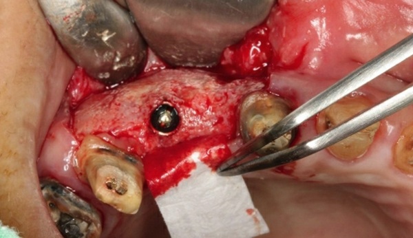 嚴重骨脊萎縮增寬手術