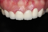 全瓷假牙