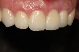 全瓷假牙