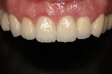 全瓷假牙