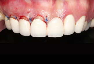 全瓷假牙