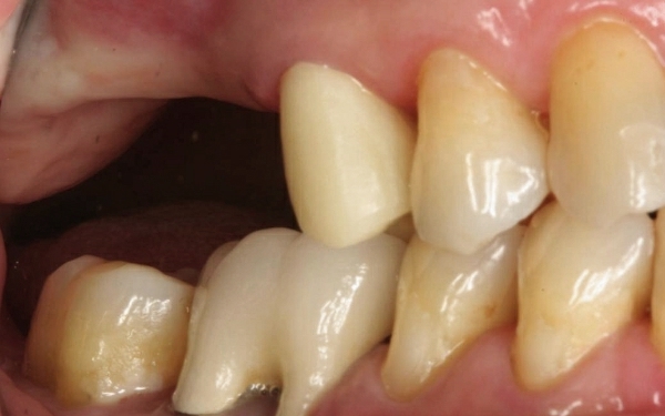 上頷竇微創增高手術