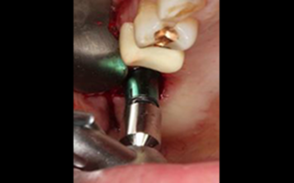 上頷竇微創增高手術