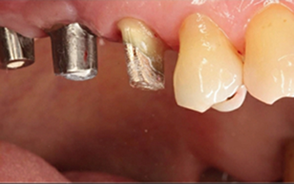 上頷竇微創增高手術