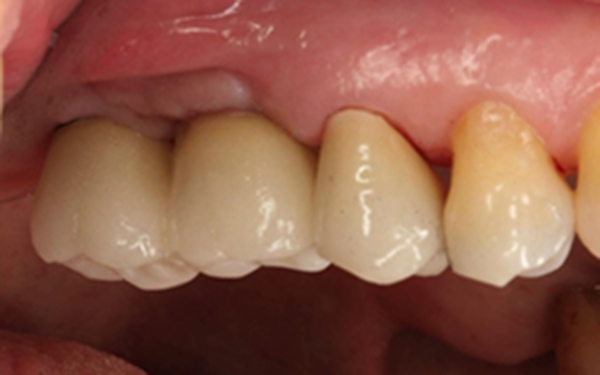 上頷竇微創增高手術