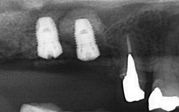 上頷竇微創增高手術