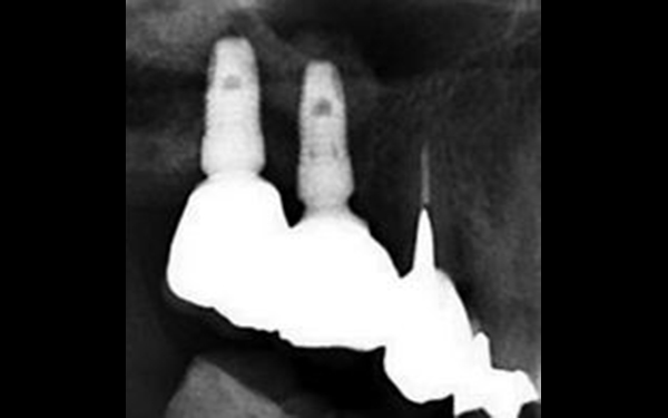 上頷竇微創增高手術