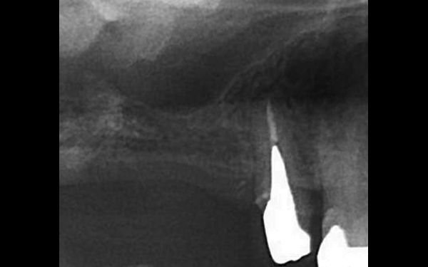上頷竇微創增高手術