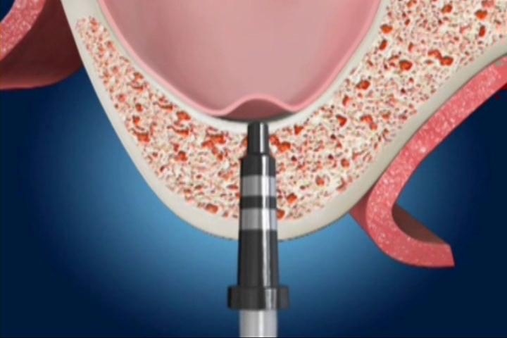 上頷竇微創增高手術