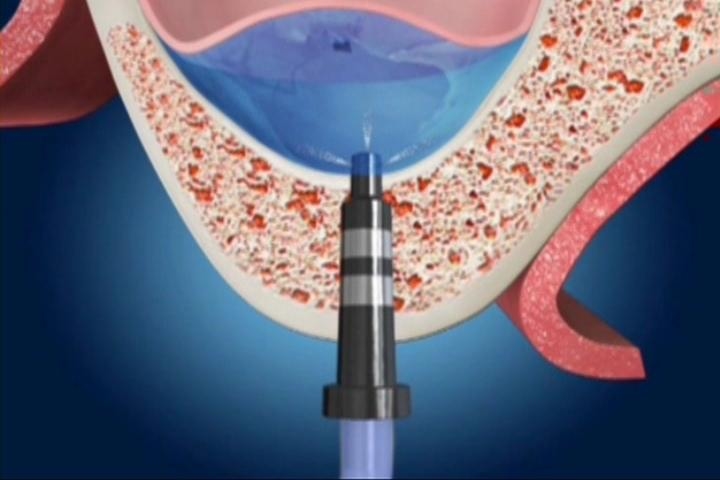 上頷竇微創增高手術