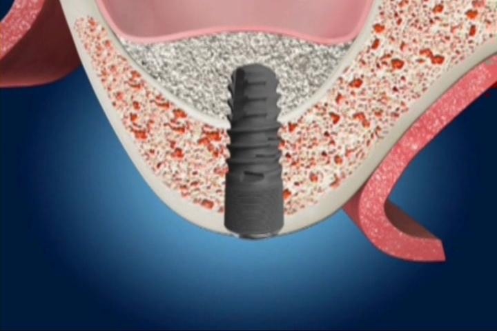 上頷竇微創增高手術