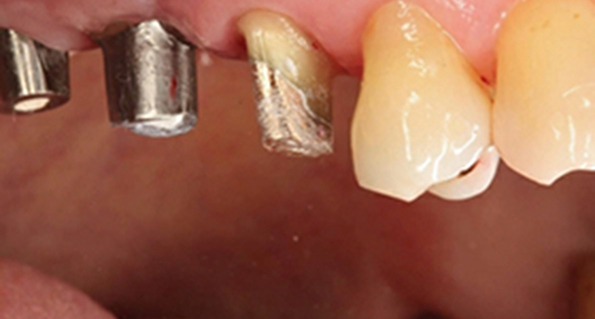 角質化牙齦增生手術