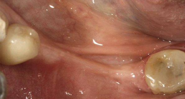 角質化牙齦增生手術