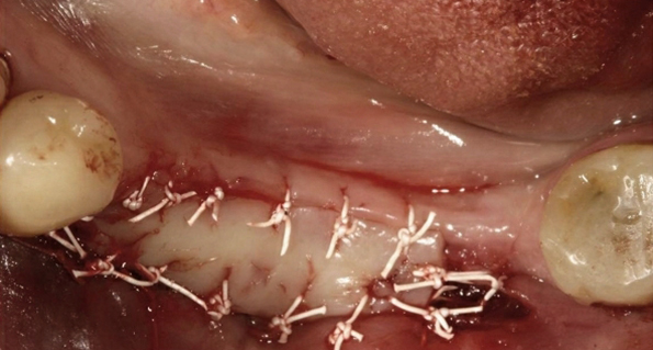 角質化牙齦增生手術