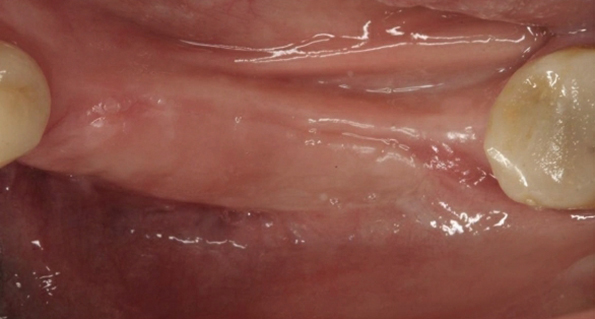 角質化牙齦增生手術