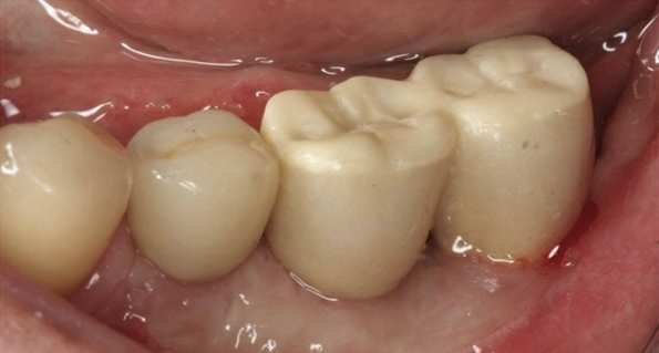 角質化牙齦增生手術