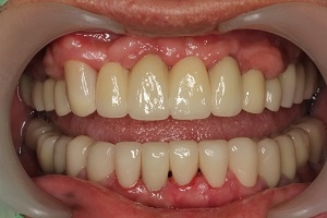 人工植牙與全口治療