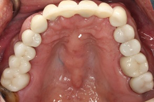 人工植牙與全口治療