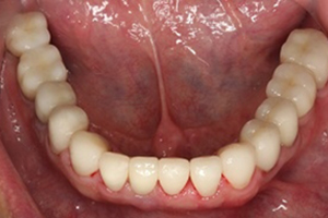 人工植牙與全口治療