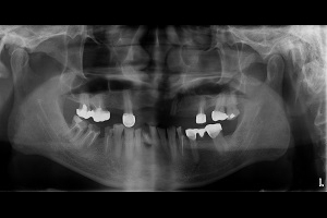 人工植牙與全口治療