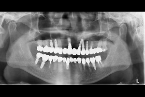 人工植牙與全口治療