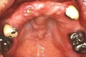 人工植牙與全口治療