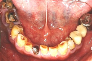 人工植牙與全口治療