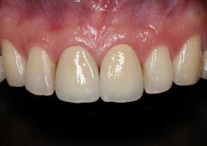 全瓷假牙