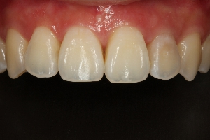 全瓷假牙