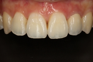 全瓷假牙