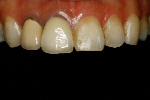 全瓷假牙