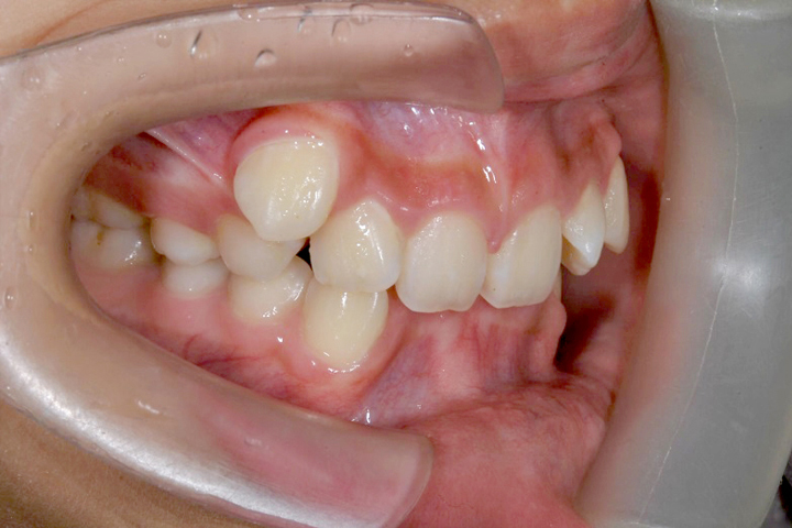 齒列不整-案例八