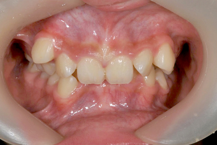 齒列不整-案例八