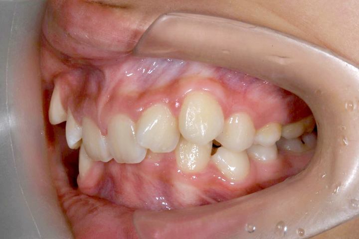 齒列不整-案例八