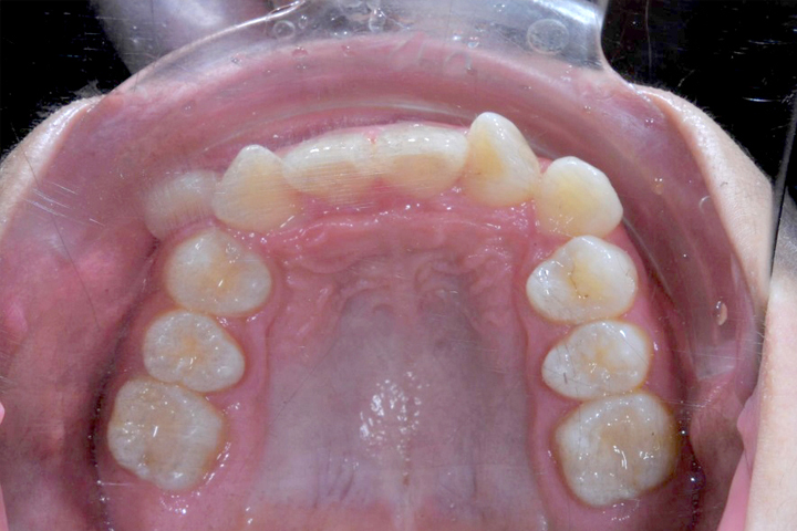 齒列不整-案例八