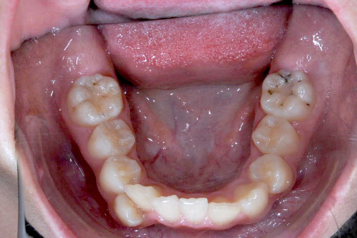 齒列不整-案例八