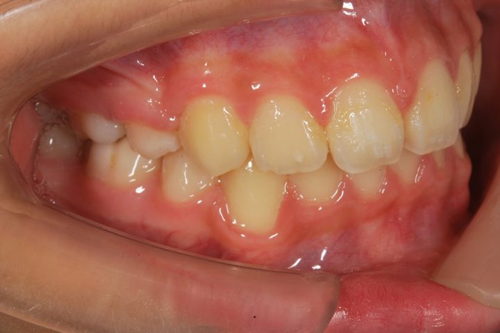 齒列不整-案例八