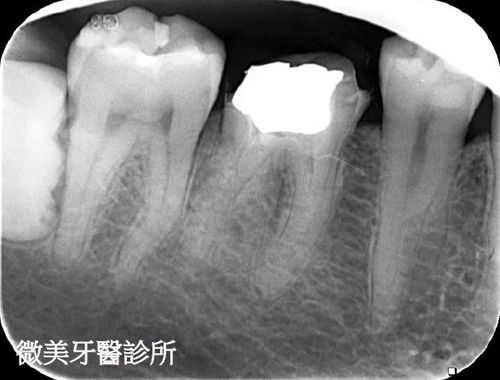 顯微根管案例分享C