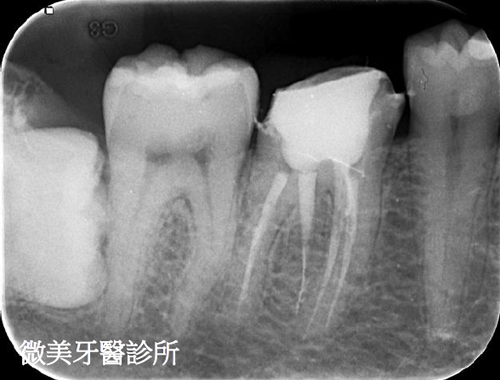 顯微根管案例分享C