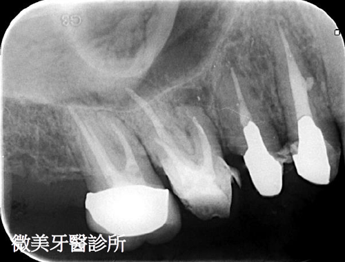 顯微根管案例分享C