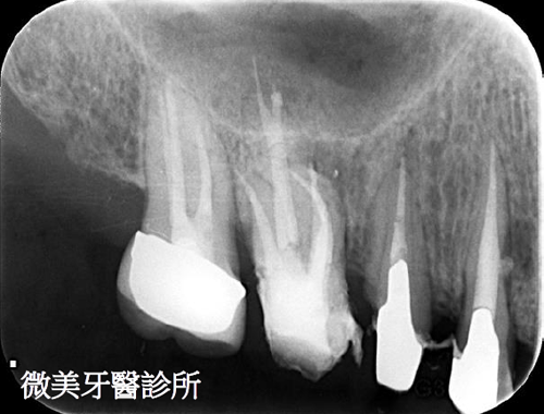 顯微根管案例分享C