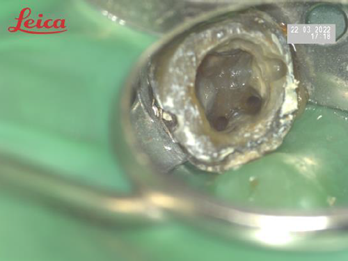 顯微根管案例分享B